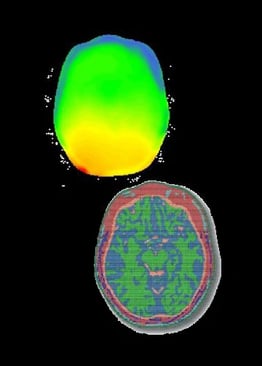 Simulación electromagnética para evaluar la seguridad de combinar electroencefalograma y resonancia magnética
